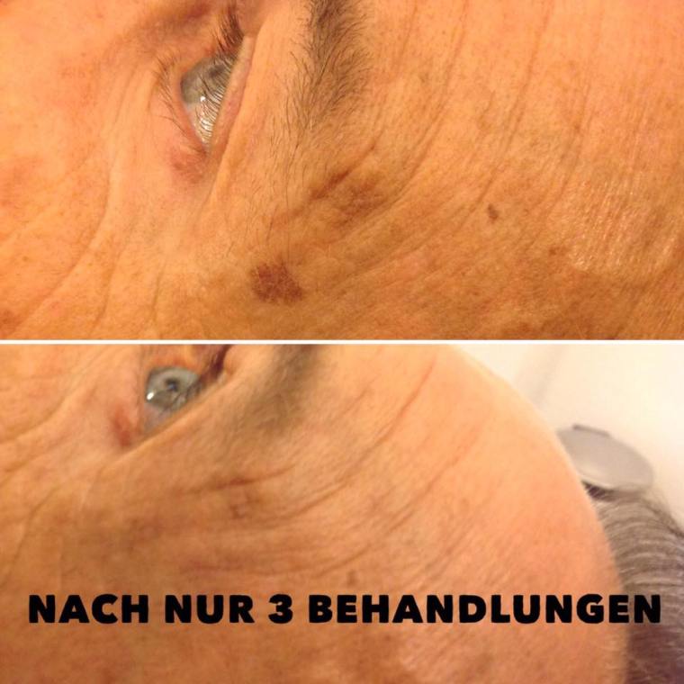 SSR Pigmentbehandlung
